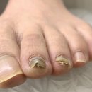 평촌스포츠센터 | 안양 평촌 무좀문제성 파고드는 발톱 고수손길