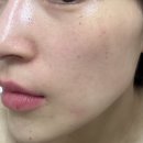 연세선우의원 | 연세선우의원 루비레이저 후기