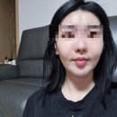 중앙제일한의원 | 홍대새살침 4번째 후기! 패인 흉터치료 합정한의원