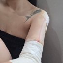 때빼멍 | 신촌 팔뚝 지방추출주사 당일후기 + 멍 붓기 통증 가격 상담내용