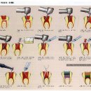 신경치료 치아의 구조 치료재료 이미지
