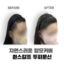 원스칼프 이미지