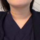 선천 | 목주름강남역목주름필러후기, 선천적 목주름 고민 이렇게 해결했어요 (강남역피부과 목주름필러)