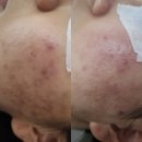 연제구-138 | 부산신부관리 받고 얼굴 윤곽 살아난 후기, 클린스킨 리얼 체험기