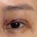 주안헬스케어 | [송도 성형 후 관리] 쌍수 1일차 붓기 빼주러 다녀온 비주안에스테틱 솔직 후기