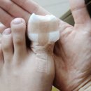 엄지유치원 | 엄지발톱들림 ::발톱빠짐, 정형외과후기