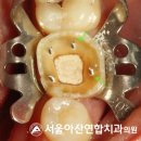 서울아산연합치과의원 | 서울아산연합 치과 어금니 크라운 수복이 필요한 이유? 보철의 적응증