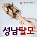 성남탈모 늦지 않게 적극적으로 증상에 대응 해야 이미지