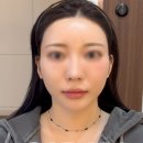 기린성형외과의원 | 인중리프팅, 귀필러 동시에 받은 사례 소개