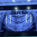 구리웰니스치과의원 | 구리 일치과 사랑니 발치 일주일 후기(내돈내뽑, 식사, 주의사항, 찜질)