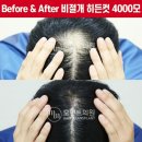첨단튼튼병원 | 모발이식병원추천 정수리탈모모발이식 결정하기 쉽지 않다면