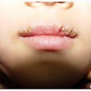 입술 구순염 원인 및 치료(연고) : 증상별 종류(박탈성 구각 접촉성 구순염) 이미지
