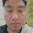 오름약국 | 노원 여드름 한의원 오름침 새살침 흉터 여드름 자국 치료 1회차 후기