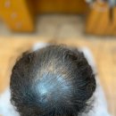 [역대급 반전] 두피페인팅도 포기한 남자! ‘토탈 탈모 성형펌’으로 인생 역전 스토리/ 부산미용실 부산탈모펌 부산남자머리 부산동래구미 이미지