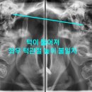 예뻐진의원 | 비수술 안면비대칭 교정 후 예뻐진 20대 여성(전후 사진, 방법, 비용)