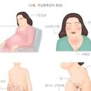 스테로이드 부작용 쿠싱 증후군이란? 증상과 원인 가수 이은하 이미지