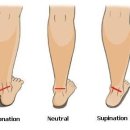 발 아치 무너짐 무릎,허리통증까지 유발! ​ 이미지