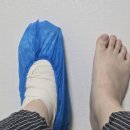 태릉마이크로의원 | 발가락 골절 수술 후기 (좌측 4족지)