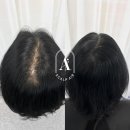 촘촘 스칼프 네이버블로그