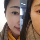 에스테틱공간 직쏘 얼굴형 윤곽케어｜강남역피부관리 후기