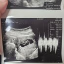 이경미산부인과의원 | [임신기록] 10주차 서브병원 방문 / 증상 공유