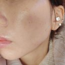 부천 청담나인성형외과 에서 실펌엑스 받은 후기 통증 과정 효과 공유