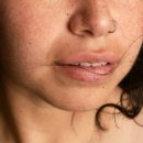 광명리 | 겨울 피부가 회복되지 않는 이유, 광명리쥬란이 필요한 시점