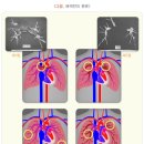 폐색전증(폐동맥 색전증, 심부 정맥 혈전증) 이미지