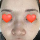 엘리스의원 | 대전 앨리스 의원 루비레이저 후기