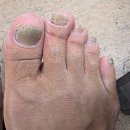 개발바닥친구들 | 아시모토 노젠EX 솔직후기, 발바닥 습진 무좀처럼 보였던 발 상태 2주 기록