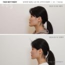 르수플