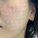 강남닥터에버스의원 | 닥터에버스 마곡점 : 물광주사 2.5cc 내돈내산 후기