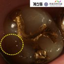 인천어바웃유외과의원 | [계산동치과] 환자와 의사를 모두 좌절시키는 크랙 - &#39;수직치근파절&#39;