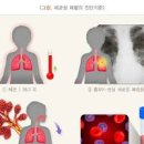 급성 폐렴 원인 증상 치료 폐렴구균 이미지