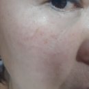 불꽃 인셀덤 | 친구들6월 2일- 22일째, 인셀덤 사용후기 자동