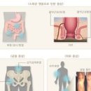 염증성장 종류와 개선방법 이미지