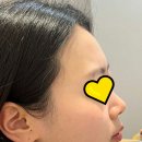 아이디병원 | 울쎄라 정품 인증 병원 아이디 피부과 뉴울쿼 후기 공유