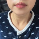 광양더사랑치과의원 | [사랑니발치/사랑니발치전문] &#39;압구정사랑이아프니구강악안면외과치과의원&#39; 사랑니 4개 발치 후기