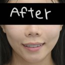 J Plant 치과기공소 | 오브제로 라미네이트 가격과 후기200% 대만족 ㅣ 송파치과