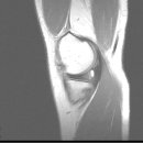 무릎 MRI 촬영했는데요 (사진) 이미지