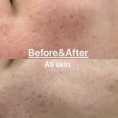 시외버스정류장_킹덤웨딩 | 흉터없이 여드름케어 완벽한 올스킨 내돈내산 청주피부관리