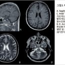 자가면역 난치성 다발성경화증에 대하여 이미지