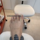 나도손톱 레푸스 개봉점 이미지