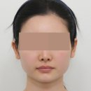 더왈츠의원 | 턱보톡스 인모드, 시술 순서 및 효과 분석 (소중한 환자분의 후기)