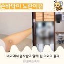 에스병원 | 손바닥이 노래요 순천에스병원 내과 방문후기 황달 간경화 뭘까
