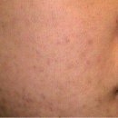 천지한의원 | 대구여드름치료 후기! 4개월 간의 피부 변천사