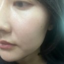 (주)제이시스메디칼 | 분당피부과 모공관리 포텐자 콜라스터 통증효과 내돈내산 후기