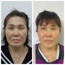 사계절예쁨의원 | 울쎄라 + 레디어스 : 최강의 시술 조합.(직원 부모님 시술후기 2탄)