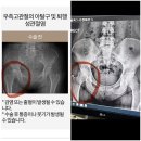 [평촌]서울나우병원 고관절전문병원, 30대 고관절비구이형성증 인공관절 수술후기_윤필환원장님