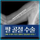 팔 골절 수술(ORIF) 후 회복 기간은 얼마나? 철심 제거 시기는?